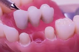 Image of Root Canal Treatment