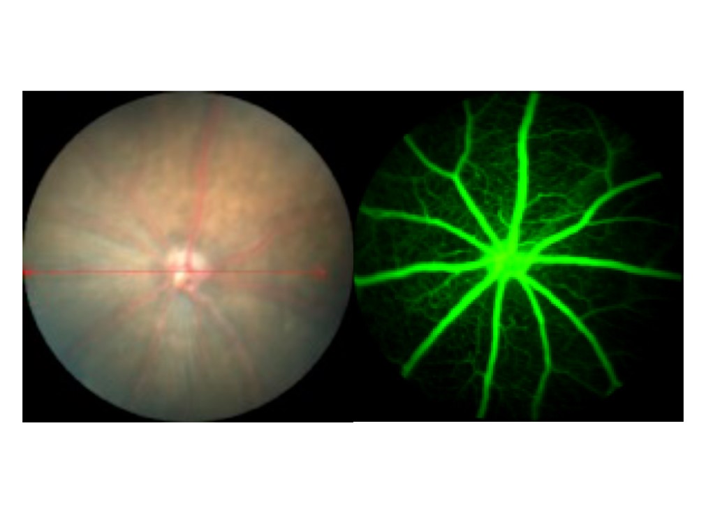 Dry AMD