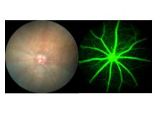 Dry AMD